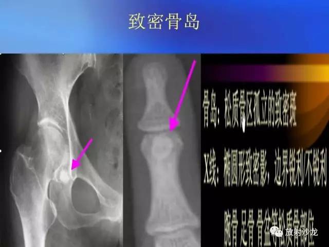 【PPT】骨、关节X线表现、正常变异