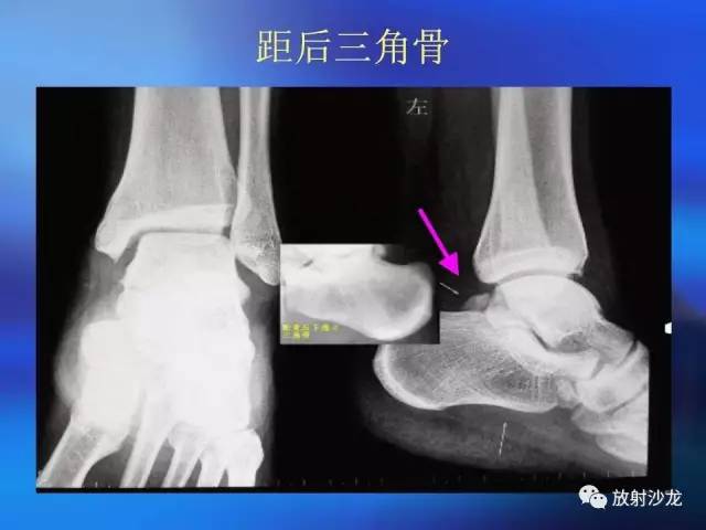 【PPT】骨、关节X线表现、正常变异
