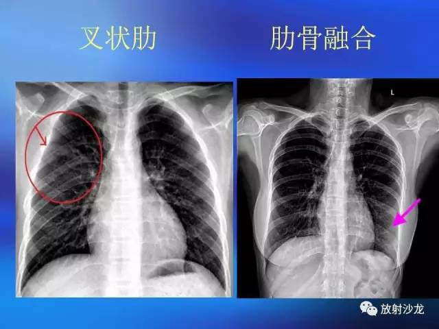【PPT】骨、关节X线表现、正常变异