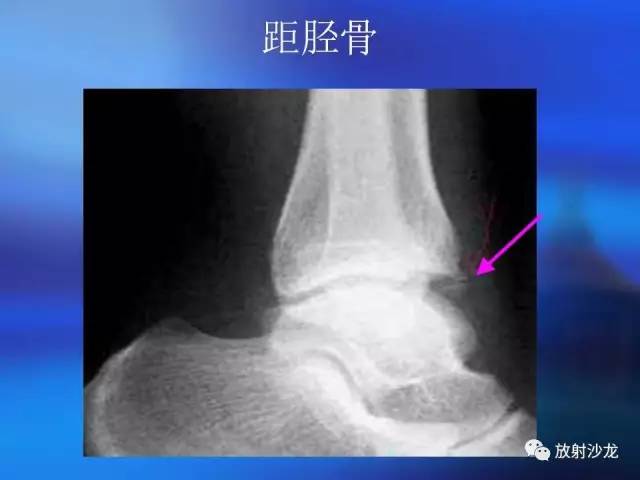 【PPT】骨、关节X线表现、正常变异