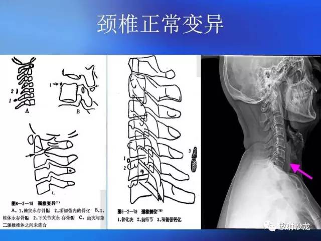 【PPT】骨、关节X线表现、正常变异