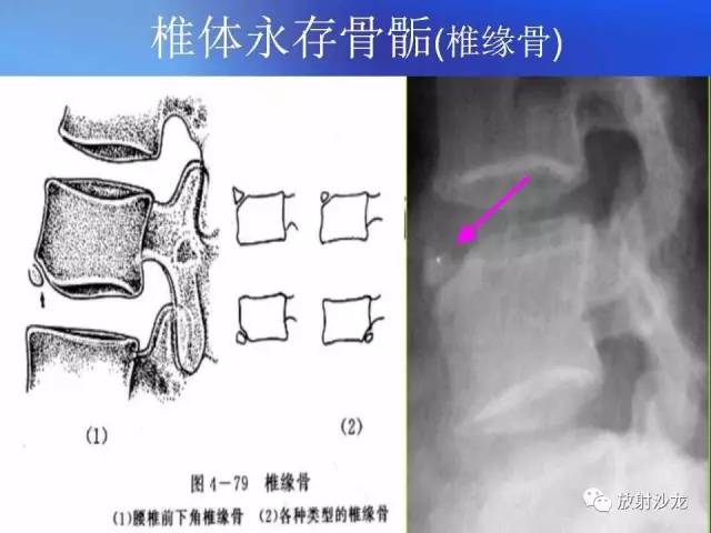 【PPT】骨、关节X线表现、正常变异