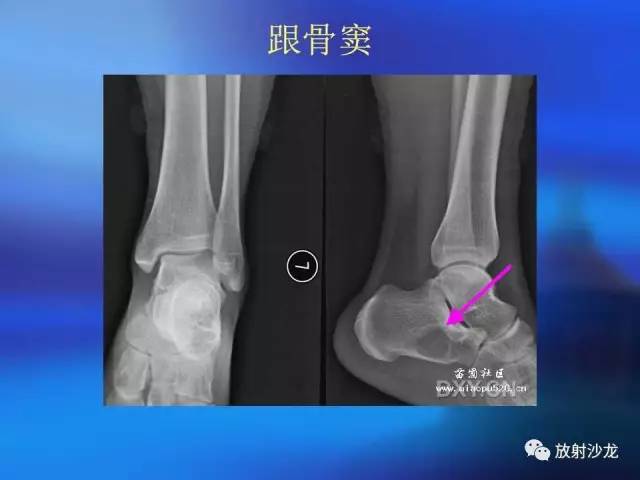【PPT】骨、关节X线表现、正常变异
