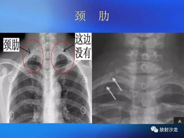 【PPT】骨、关节X线表现、正常变异