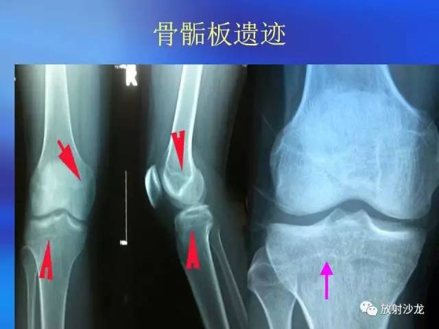 【PPT】骨、关节X线表现、正常变异