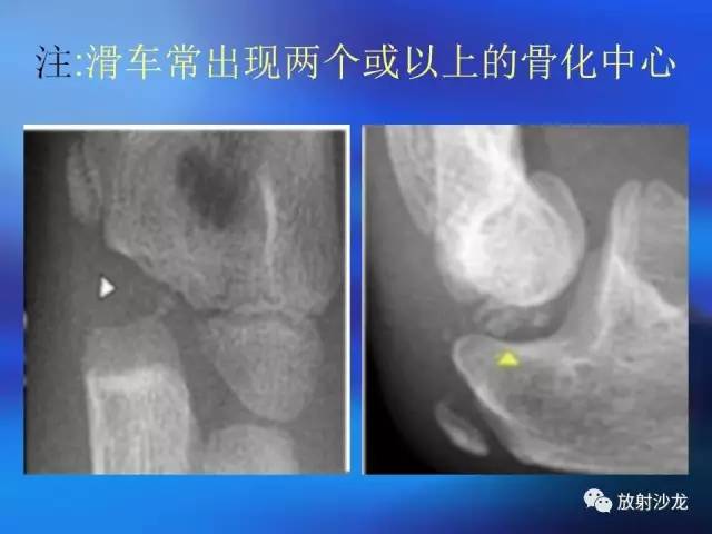【PPT】骨、关节X线表现、正常变异