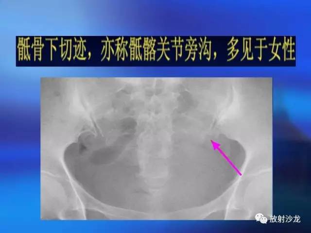 【PPT】骨、关节X线表现、正常变异