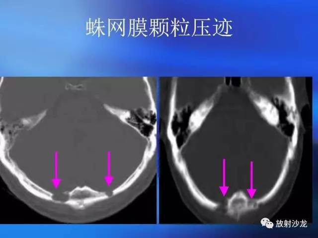 【PPT】骨、关节X线表现、正常变异