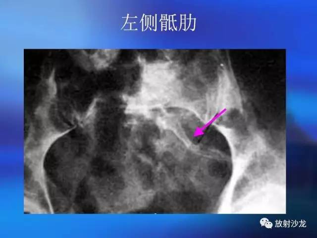 【PPT】骨、关节X线表现、正常变异