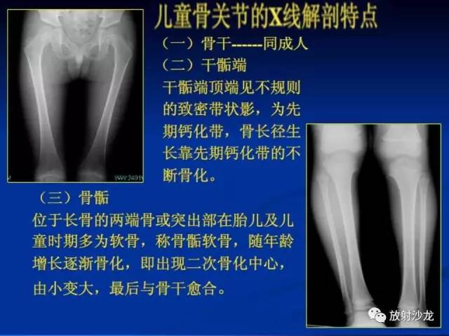 【PPT】骨、关节X线表现、正常变异