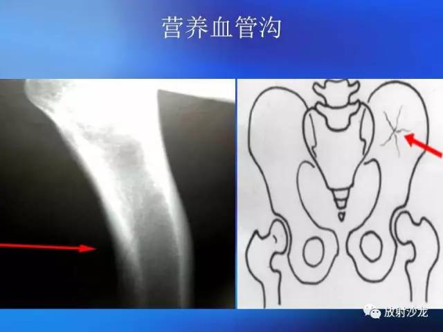 【PPT】骨、关节X线表现、正常变异