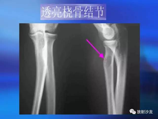 【PPT】骨、关节X线表现、正常变异