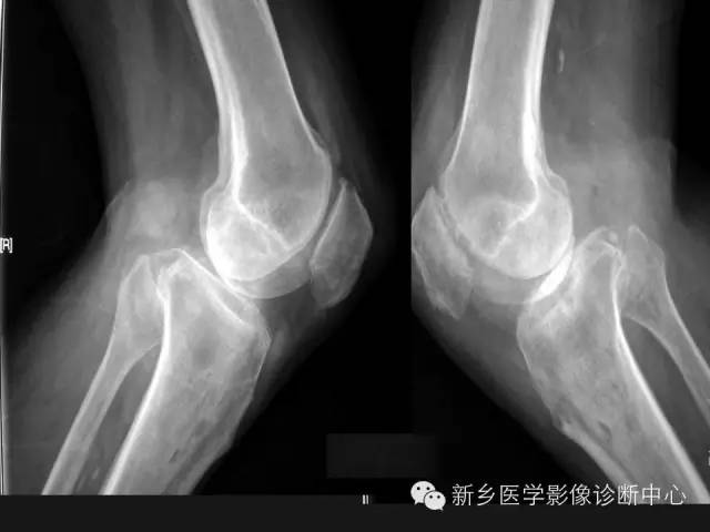 【病例】痛风1例X线影像表现