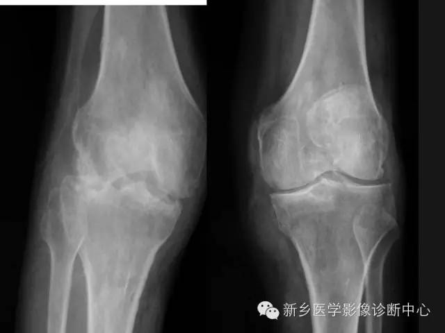 【病例】痛风1例X线影像表现
