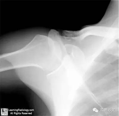 【病例】锁骨远端骨质溶解1例X线影像表现