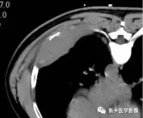 发生在肋骨上的15种肿瘤