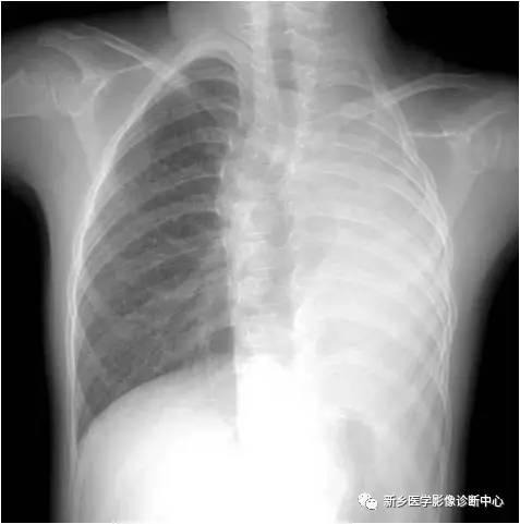 12种肺部发育异常，您知道几种？
