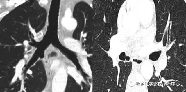 12种肺部发育异常，您知道几种？