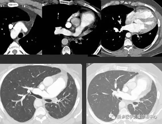 12种肺部发育异常，您知道几种？