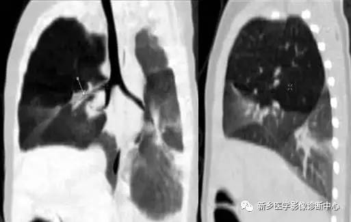 12种肺部发育异常，您知道几种？