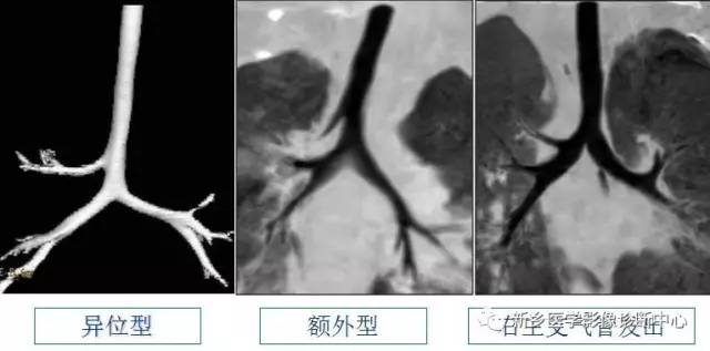 12种肺部发育异常，您知道几种？