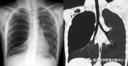 12种肺部发育异常，您知道几种？