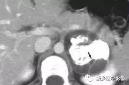 18种胰腺肿瘤，您掌握了吗？