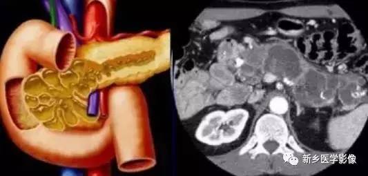 18种胰腺肿瘤，您掌握了吗？