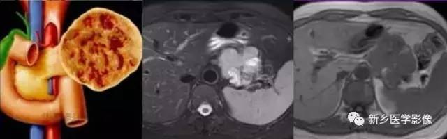 18种胰腺肿瘤，您掌握了吗？