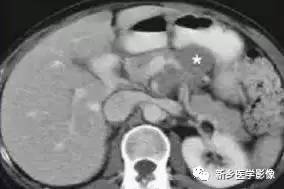 18种胰腺肿瘤，您掌握了吗？