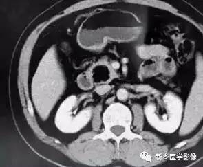 18种胰腺肿瘤，您掌握了吗？