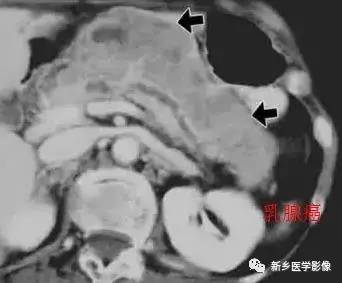 18种胰腺肿瘤，您掌握了吗？