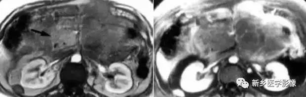 18种胰腺肿瘤，您掌握了吗？