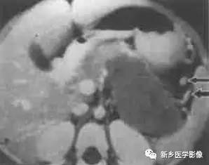 18种胰腺肿瘤，您掌握了吗？