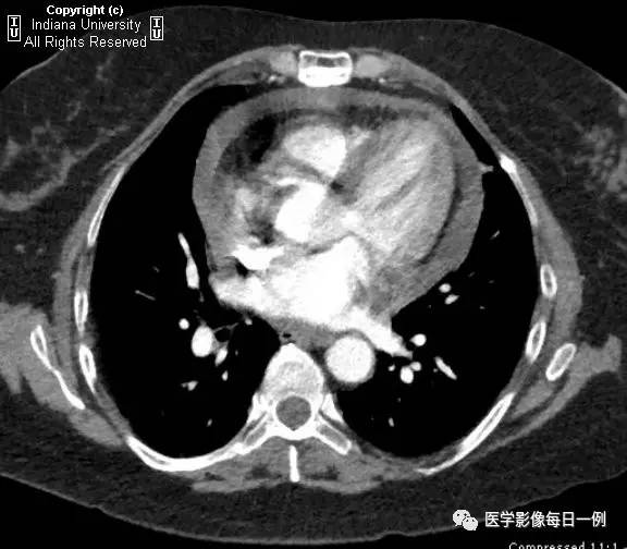 【病例】类风湿性关节炎继发心包积液1例X线CT