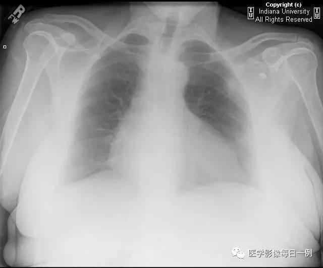 【病例】类风湿性关节炎继发心包积液1例X线CT