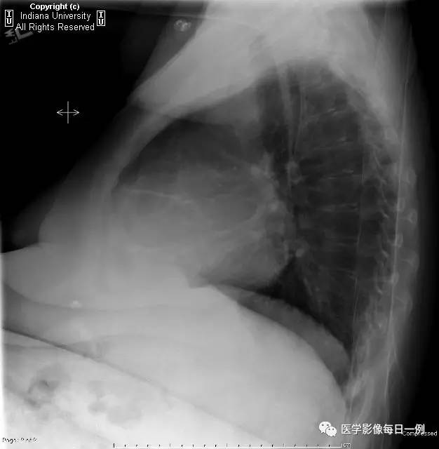【病例】类风湿性关节炎继发心包积液1例X线CT