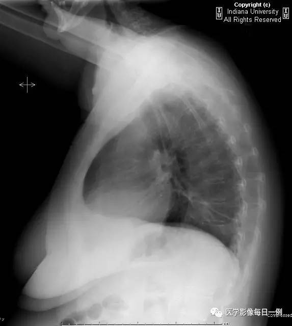 【病例】类风湿性关节炎继发心包积液1例X线CT