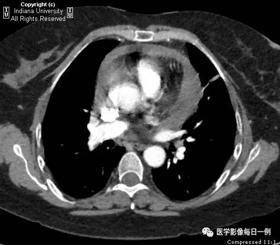 【病例】类风湿性关节炎继发心包积液1例X线CT