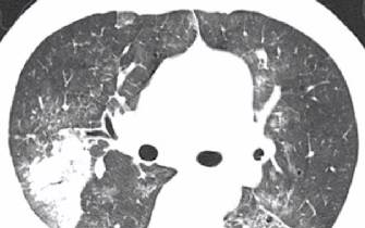 磨玻璃影？警惕9大感染性疾病