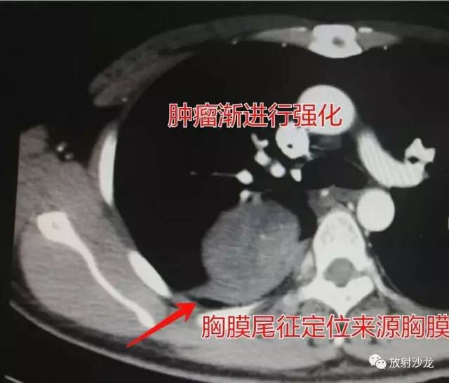 【病例】肺硬化性血管瘤1例CT影像讨论