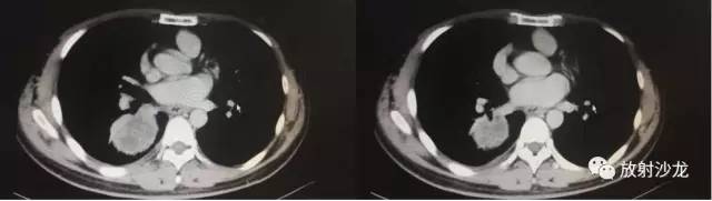 【病例】肺硬化性血管瘤1例CT影像讨论