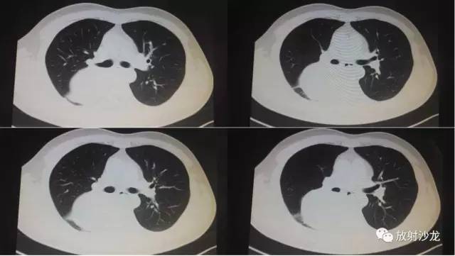 【病例】肺硬化性血管瘤1例CT影像讨论