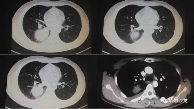 【病例】肺硬化性血管瘤1例CT影像讨论
