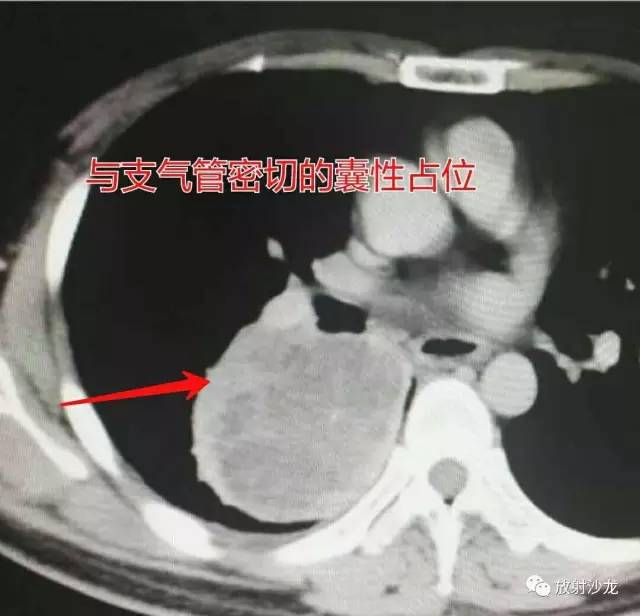 【病例】肺硬化性血管瘤1例CT影像讨论