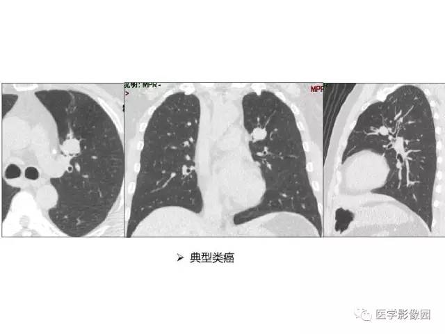 【病例】左肺门巨淋巴结增生1例CT影像分析