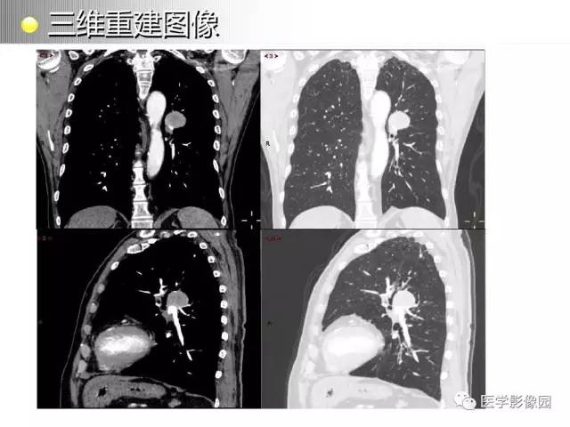 【病例】左肺门巨淋巴结增生1例CT影像分析