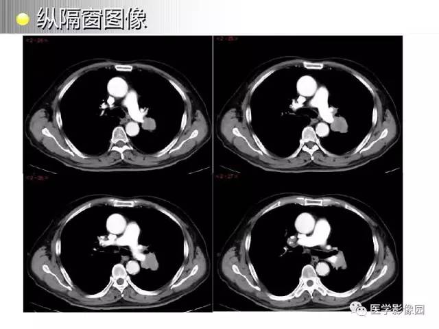 【病例】左肺门巨淋巴结增生1例CT影像分析