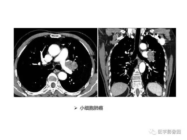 【病例】左肺门巨淋巴结增生1例CT影像分析