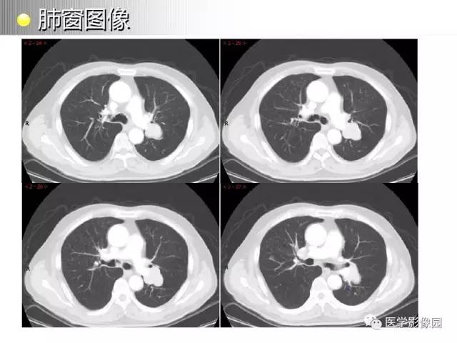 【病例】左肺门巨淋巴结增生1例CT影像分析